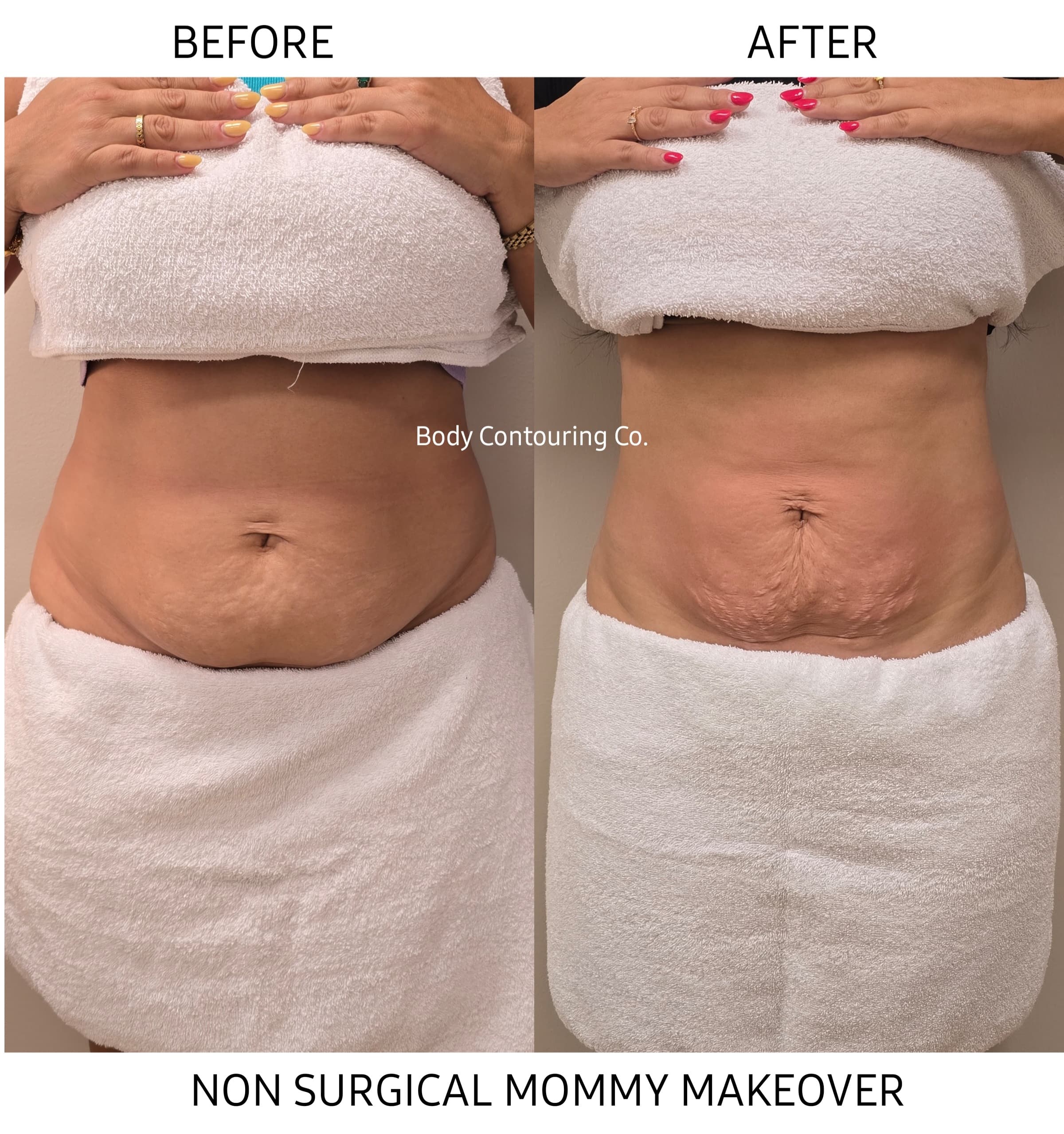 Body Contouring - Abdomen & Waist