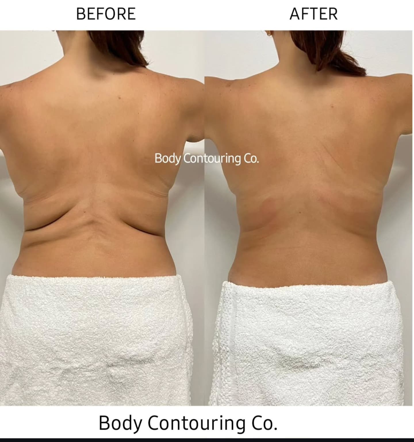Body Contouring - Side Bra Fat