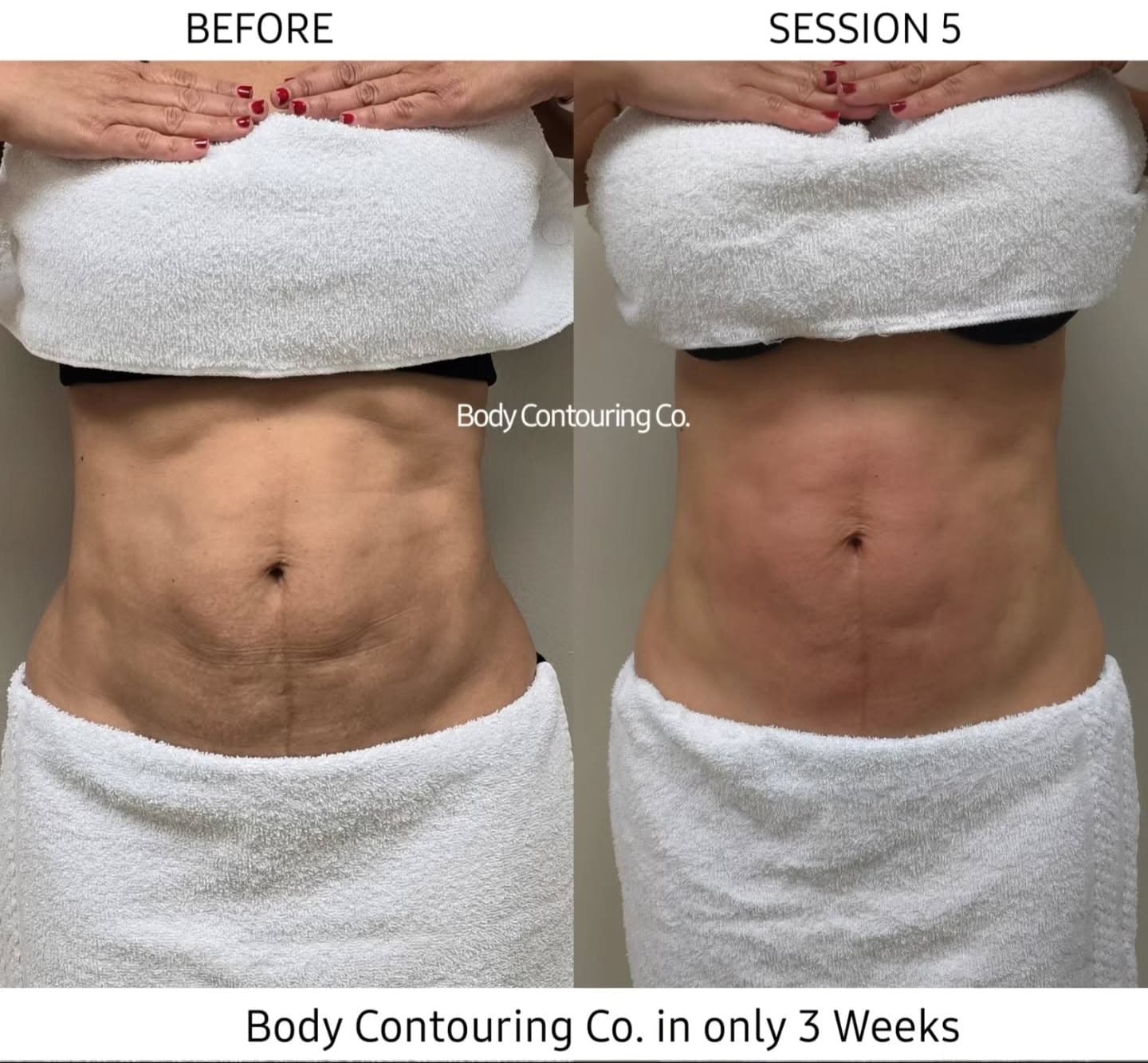 Lymphatic Massage - Fibrosis Reduction