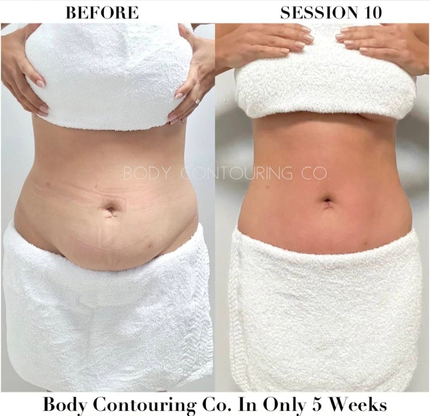 Non-Surgical Body Contouring